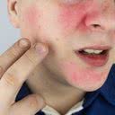 O rubor é uma dilatação dos vasos, com aumento de fluxo de sangue para a pele - iStock