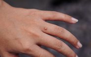 Há uma imensa variedade de subtipos de HPV que podem causar verrugas comuns - iStock