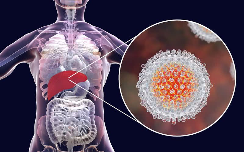 Hepatites virais atingem o fígado causando alterações leves, moderadas ou graves, e são silenciosas - iStock