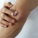 O tratamento tópico com cremes ou pomadas é indicado quando as lesões são localizadas - iStock
