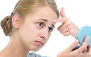 A acne é uma condição prevalente na adolescência capaz de afetar também o psicológico - iStock