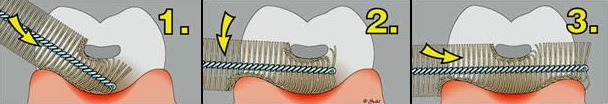 Técnica correta de utilização da escova interdental  (crédito: arquivo pessoal)